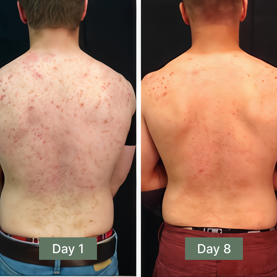 Back Acne & Dark Spot Relief Soap Bar