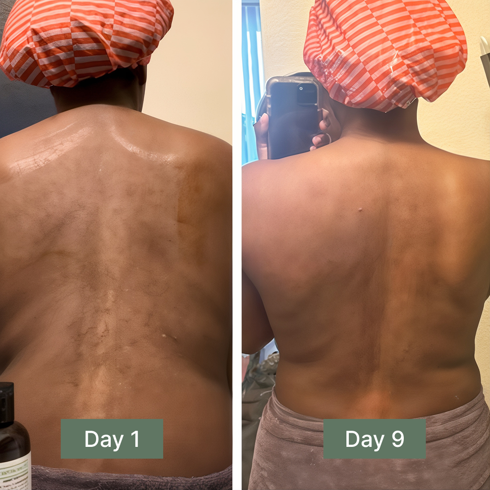 Back Acne & Dark Spot Relief Soap Bar