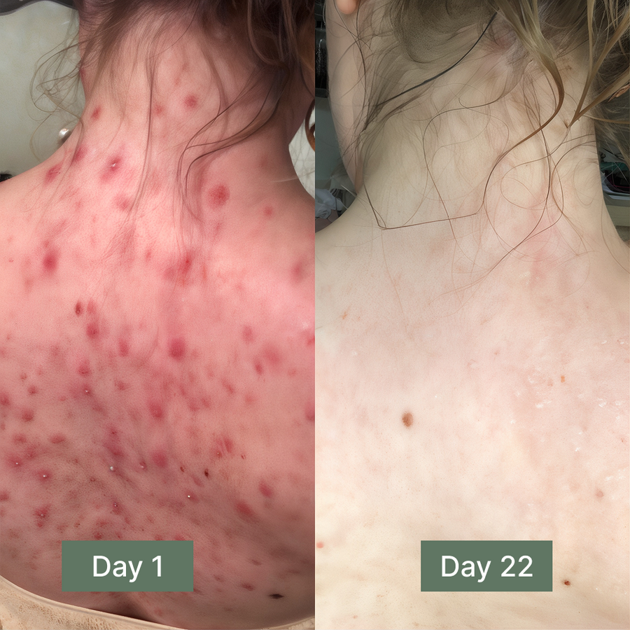 Back Acne & Dark Spot Relief Soap Bar