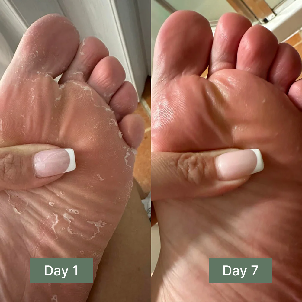 Anti Fungal Relief Soap Bar